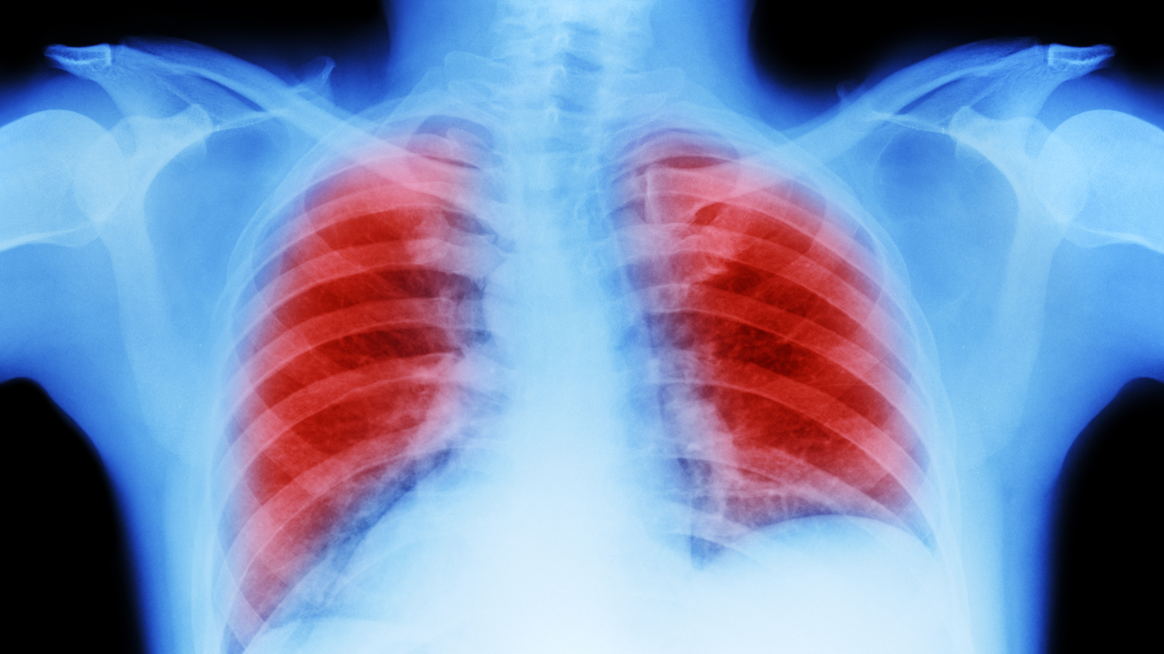 nm-should-you-lung-cancer-screening_feature