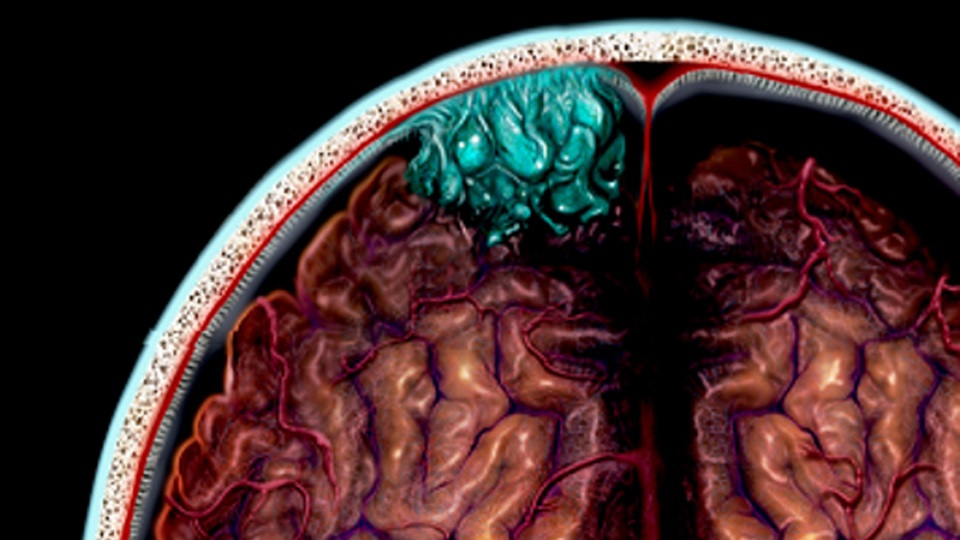 A brain tumor highlighted green within a brain scan.
