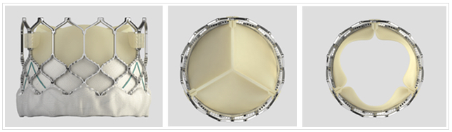 Tavr Material Transcatheter Aortic Valve Replacement | Northwestern Medicine