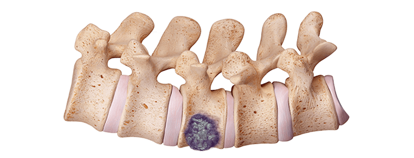 spine with chordoma
