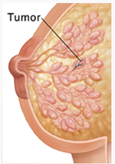 Breast tumor