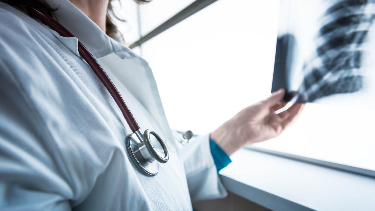Learning About Lung Cancer: Top 10 Questions | Northwestern Medicine