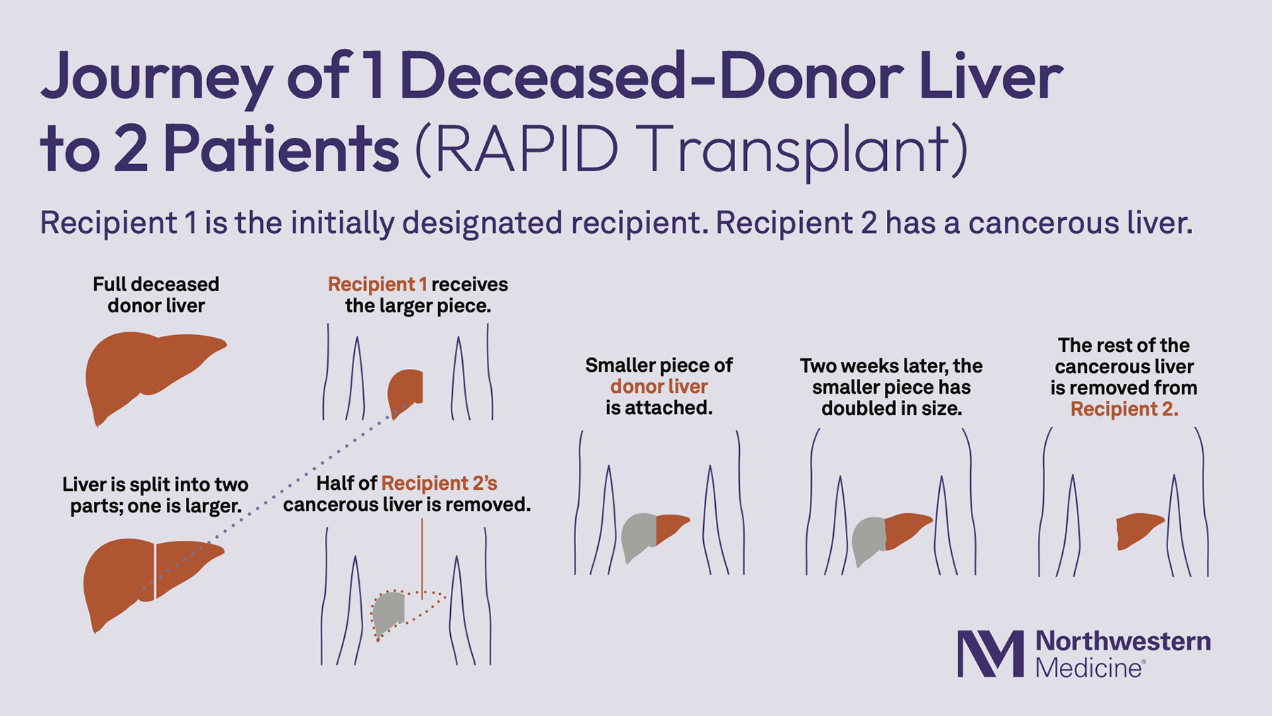 A-New-Pathway-Liver-Transplant_in3