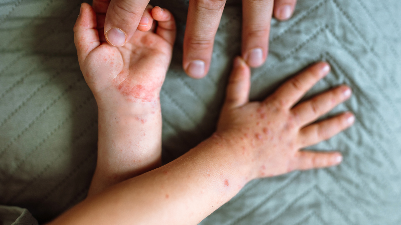 Adult hand holding a baby's hand with a red dot rash on it.