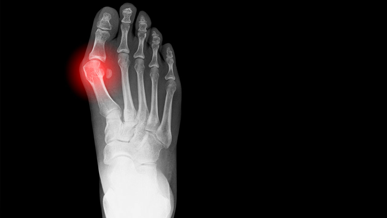 X-ray showing a bunion on a human foot.