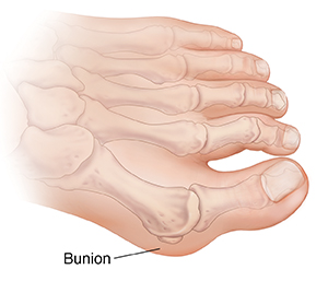 Illustration of a bunion.