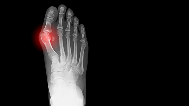 X-ray showing a bunion on a human foot.