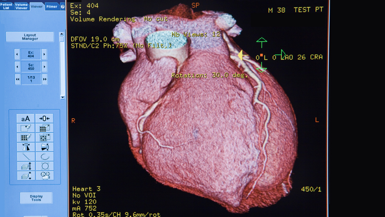 Image of a heart scan shown on a computer program.