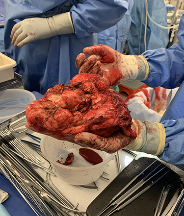 A surgeon holding a heart tumor in the operating room.