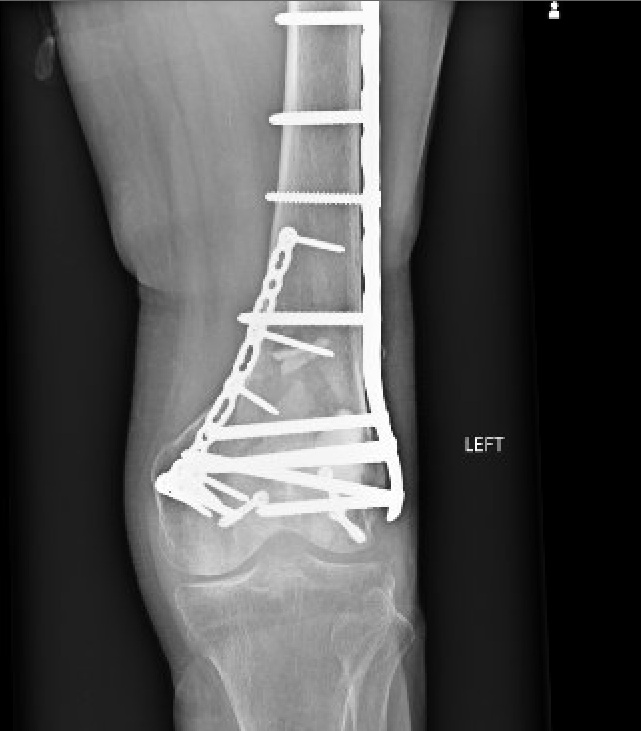 An X-ray shows an image of a distal femur fracture, which is a portion of the thigh bone.