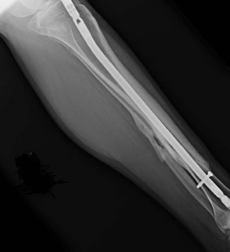 An X-ray depicts an image of a fracture of the tibial shaft, or the shin bone.
