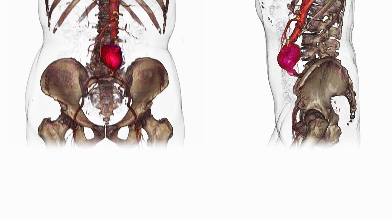 Diagram of an abdominal aortic aneurysm.  