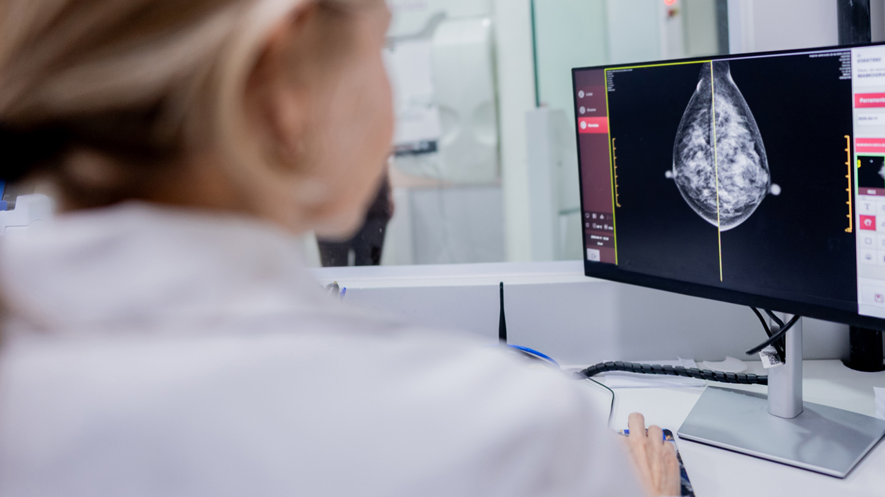 A doctor examining a mammography scan of dense breast tissue.