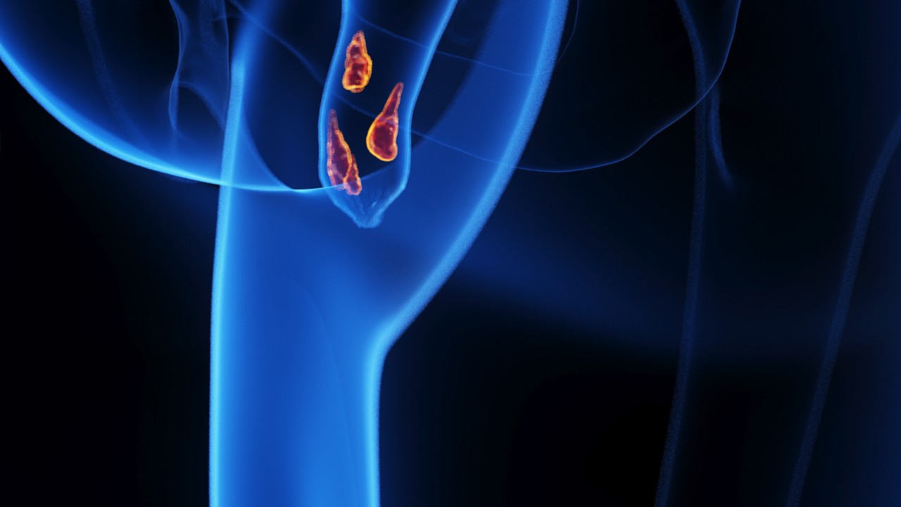 Illustration of Hemorrhoids. 