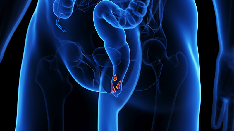 Illustration of Hemorrhoids. 