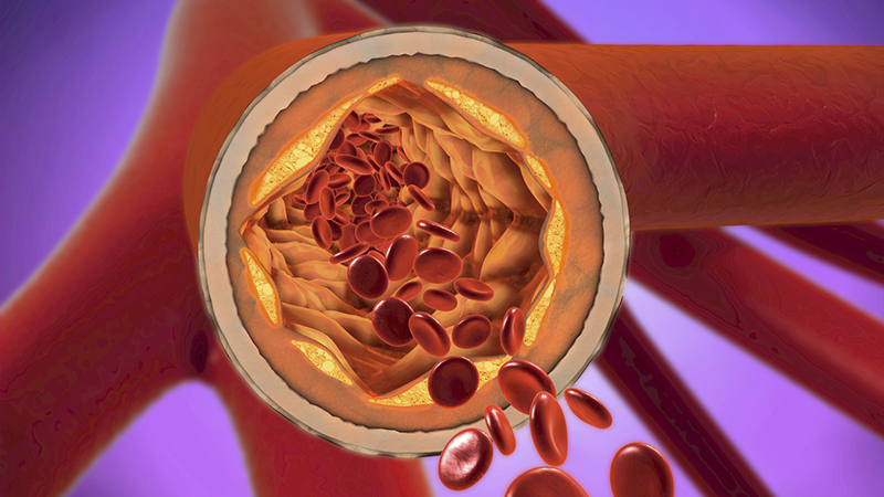 Cross-section illustration of an artery with plaque buildup in yellow and red blood cells passing through.