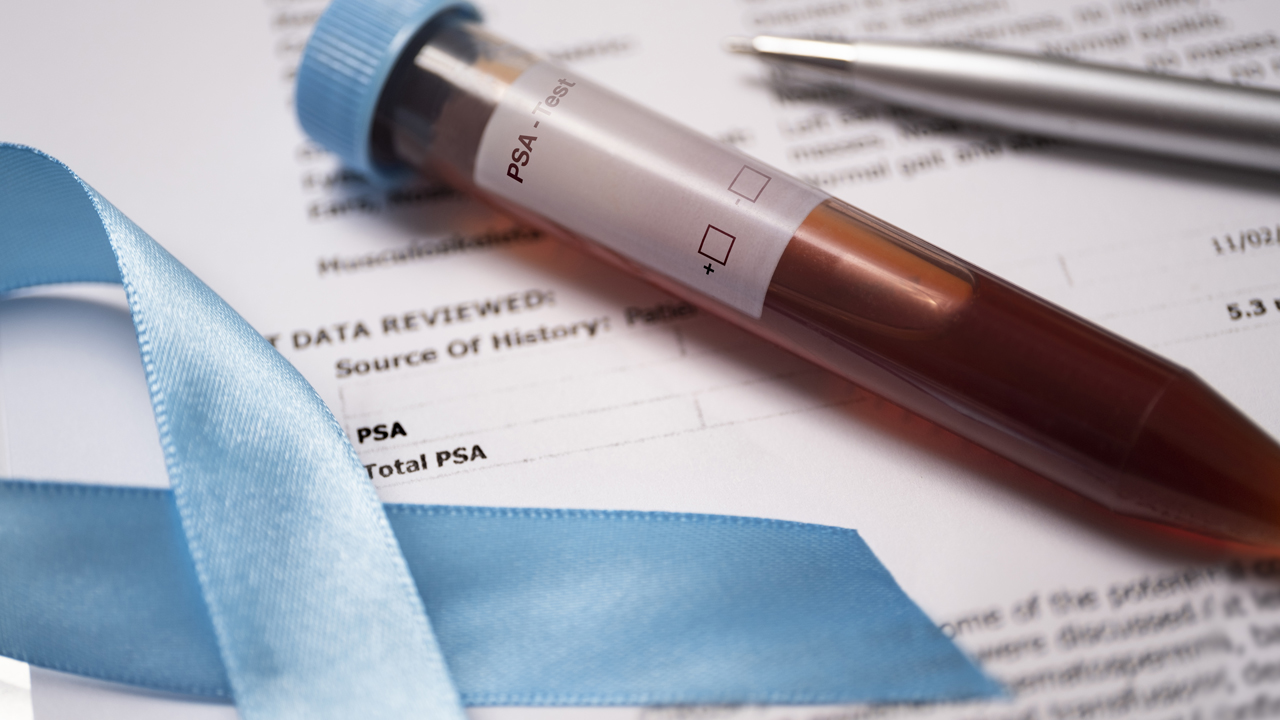 A test tube labeled as a PSA test. 