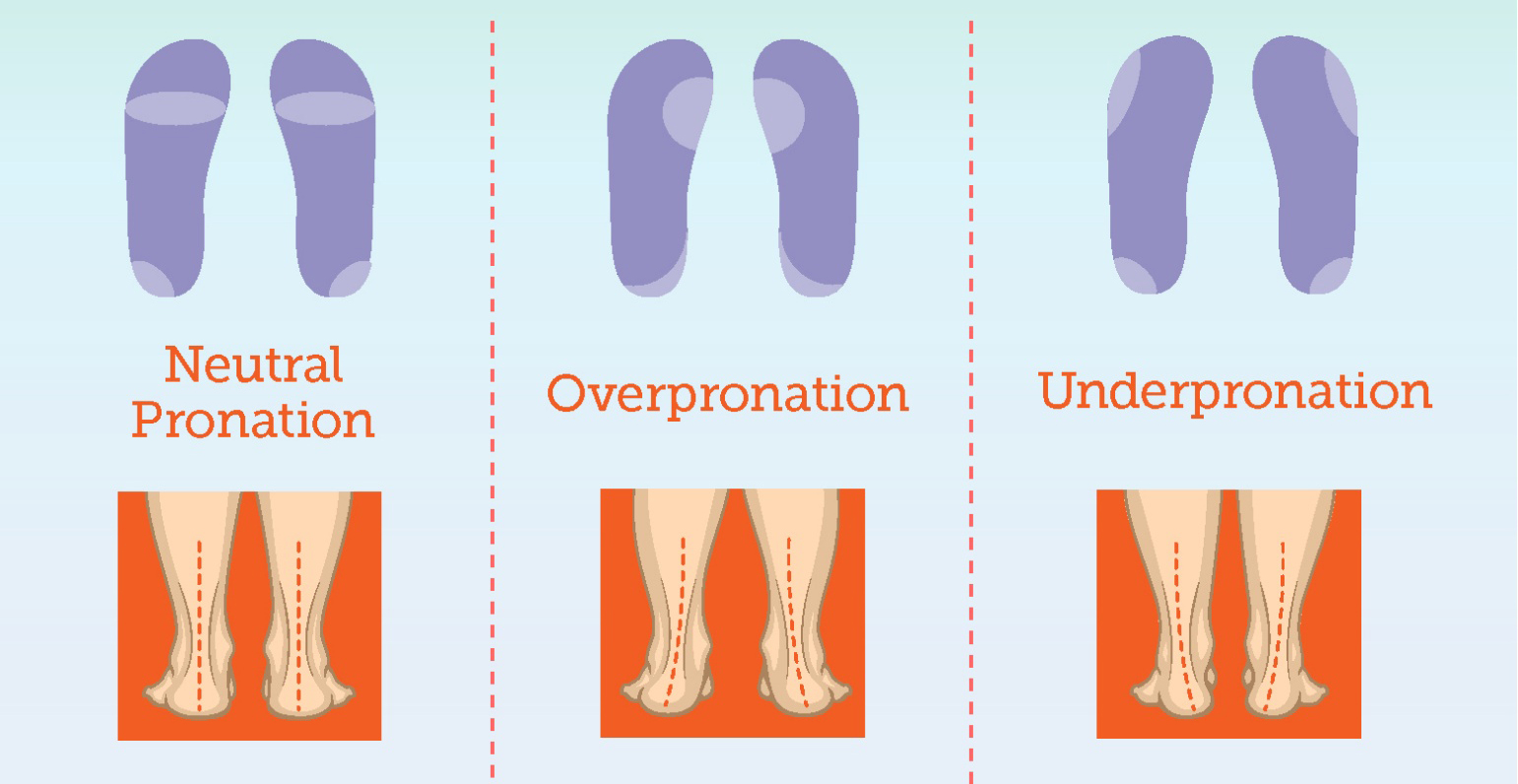 Illustration of neutral pronation, overpronation and underpronation.