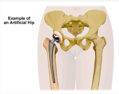 Diagram of artificial hip.
