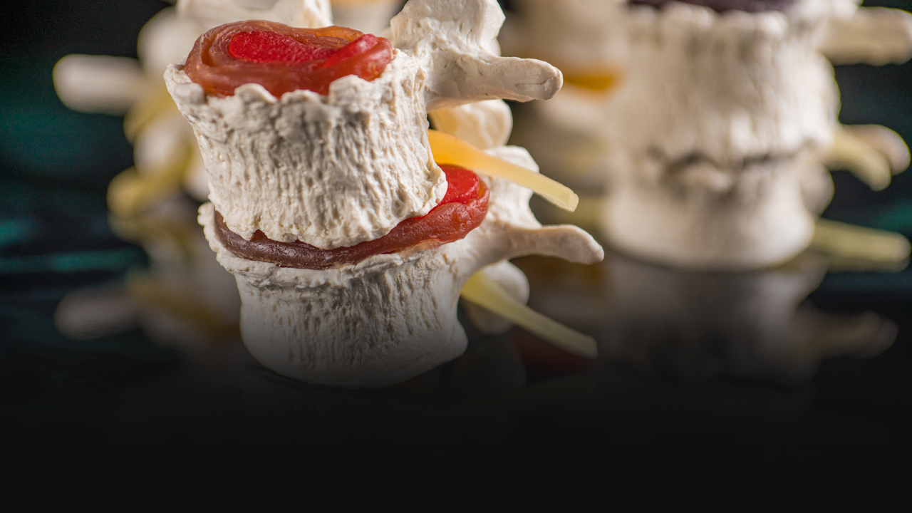 A herniated spinal disk.