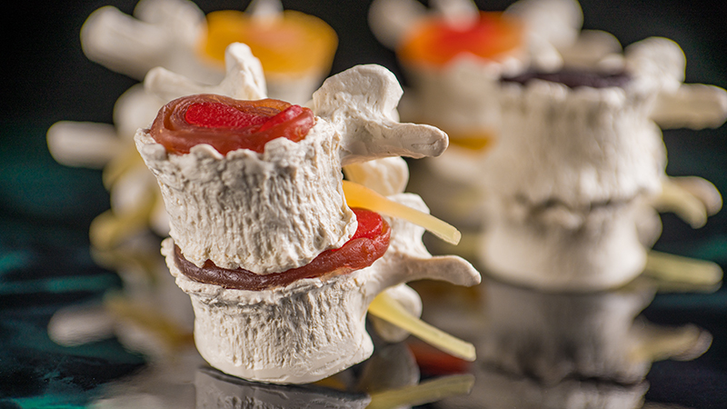 A herniated spinal disk.