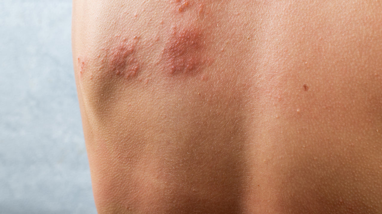 I Think I Have Shingles. Now What? | Northwestern Medicine