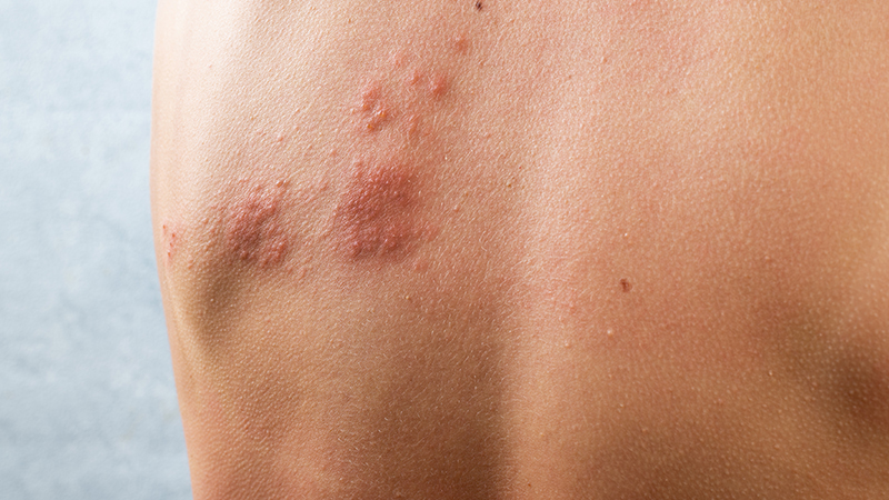 Red rash on a person's upper back.