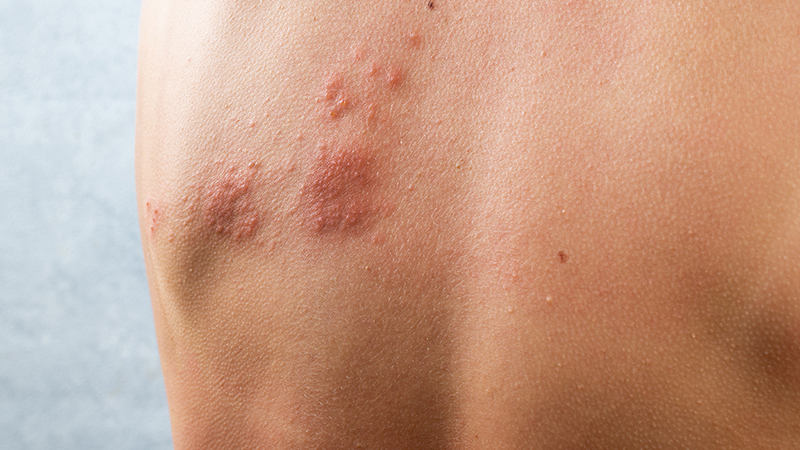 I Think I Have Shingles Now What Northwestern Medicine I Think I Have Shingles Now What Northwestern Medicine