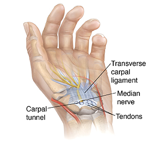 Illustration of carpal tunnel syndrome