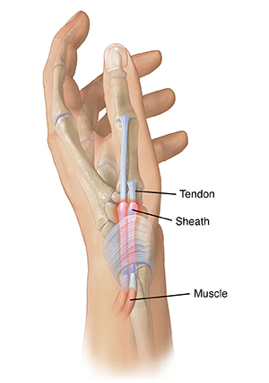 Illustration of de Quervain’s tenosynovitis 