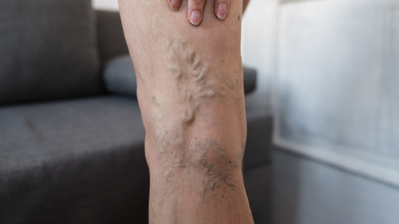 Close up of varicose veins on the back of a person’s leg.