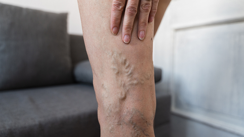Close up of varicose veins on the back of a person’s leg.