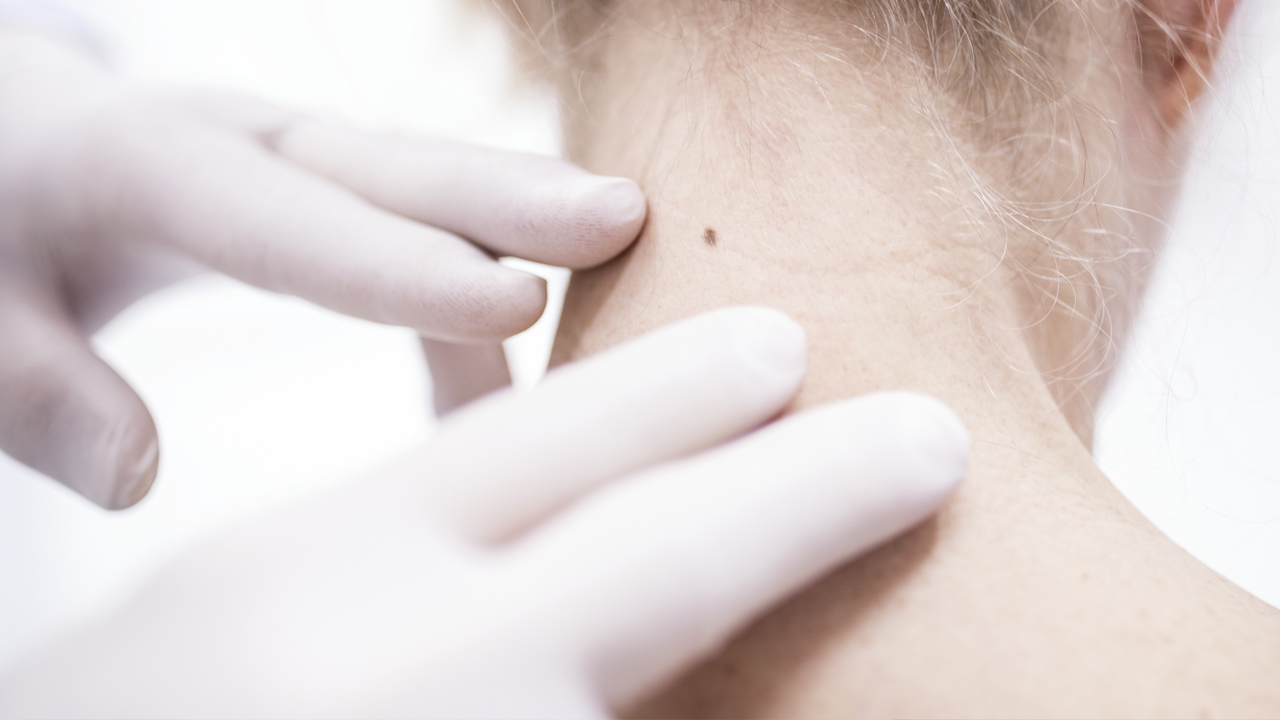 nm-mohs-surgery-questions-answers_feature