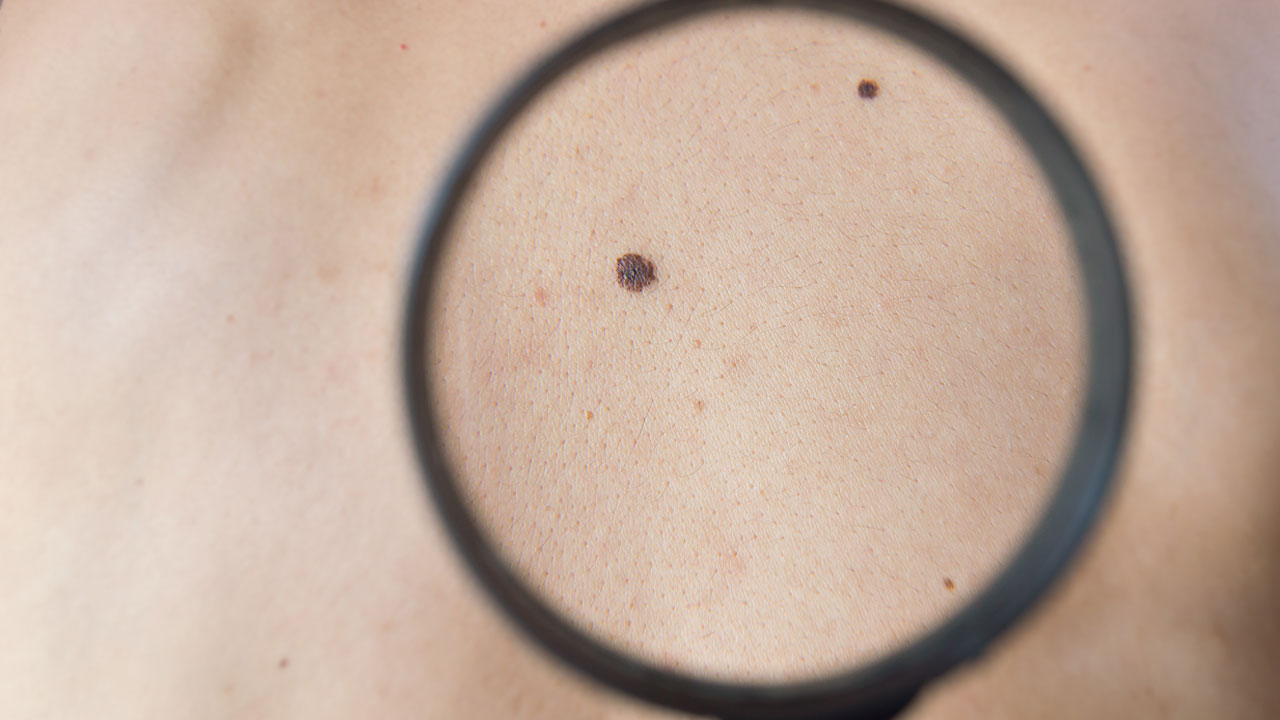 nm-what-is-melanoma_feature