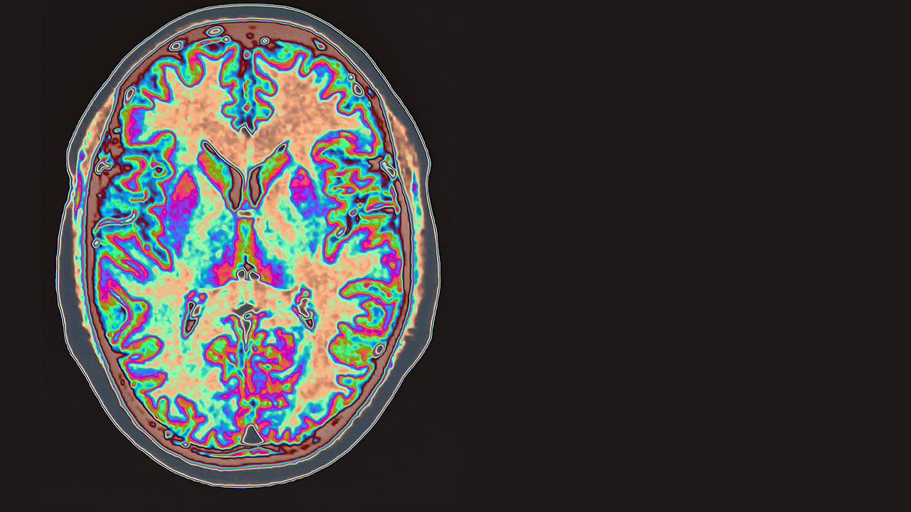 nm-when-the-immune-system-attacks-brain_feature