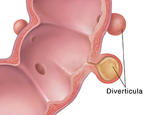 Diverticula diagram