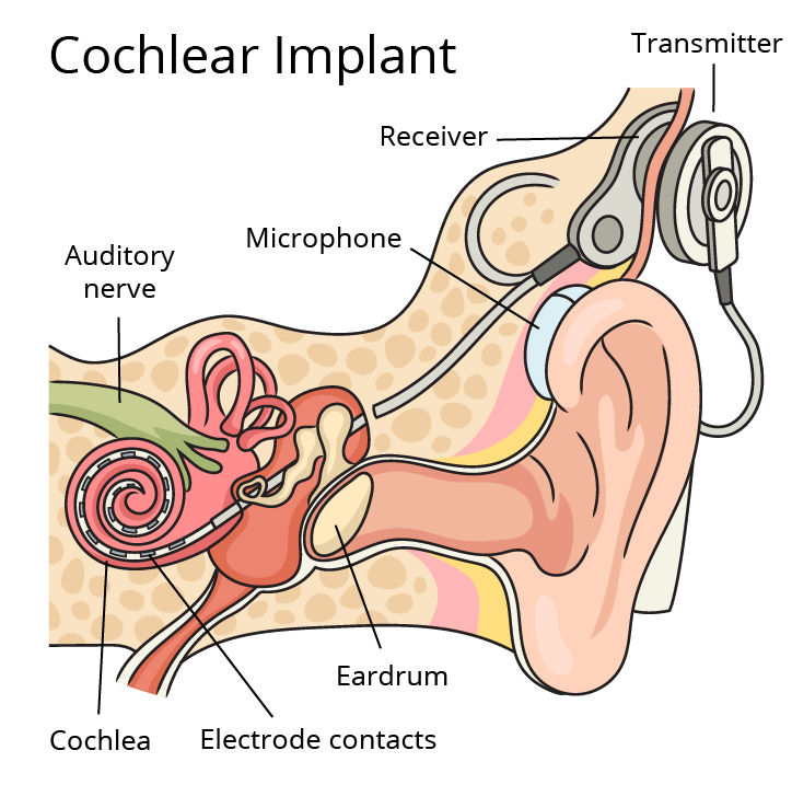 Diagram of cochlear implant.