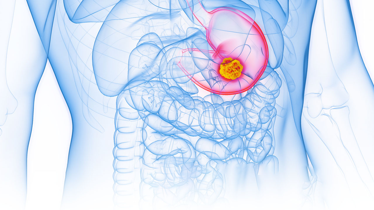 An illustration of stomach cancer.