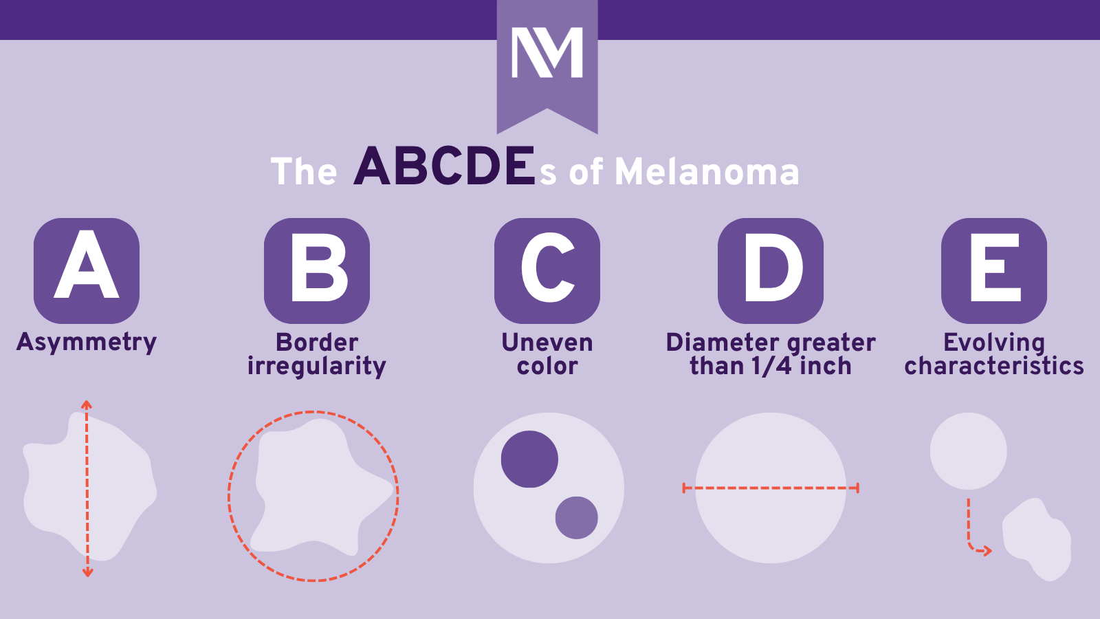 Illustration of ABCDEs of melanoma, asymmetry, border irregularity, color variations, diameter larger than 1/4 inch, and evolving appearance.