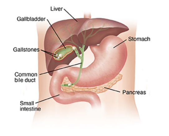 Gallbladder and gallstones diagram.