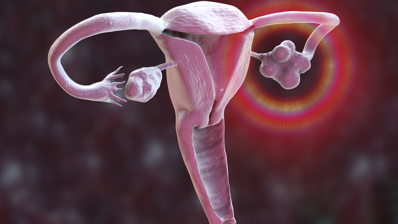 Computer illustration of reproductive system with enlarge ovaries highlighted.