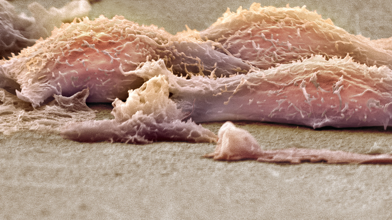 Microscopic view of a sarcoma. 