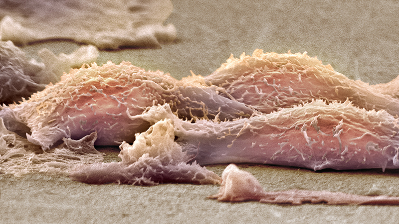Microscopic view of a sarcoma. 