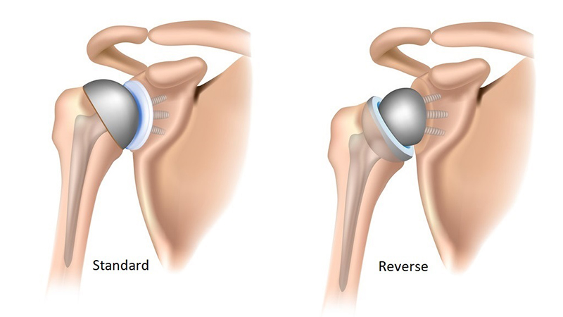 A diagram showing two different shoulder replacement types, standard and reverse.