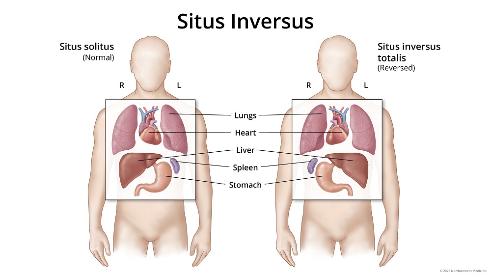 A diagram showing the normal positions of the heart, lungs, liver, spleen and stomach versus the positions of those organs in someone with situs inversus. 