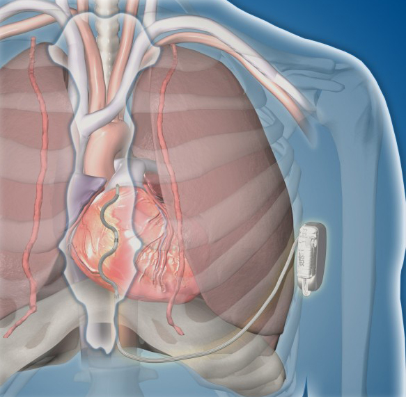 Illustration shows the human heart and placement of the extravascular implantable cardioverter defibrillator on the right side of the chest.