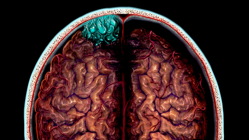 MRI cross-section image of brain in red with brain tumor between skull and brain in teal.