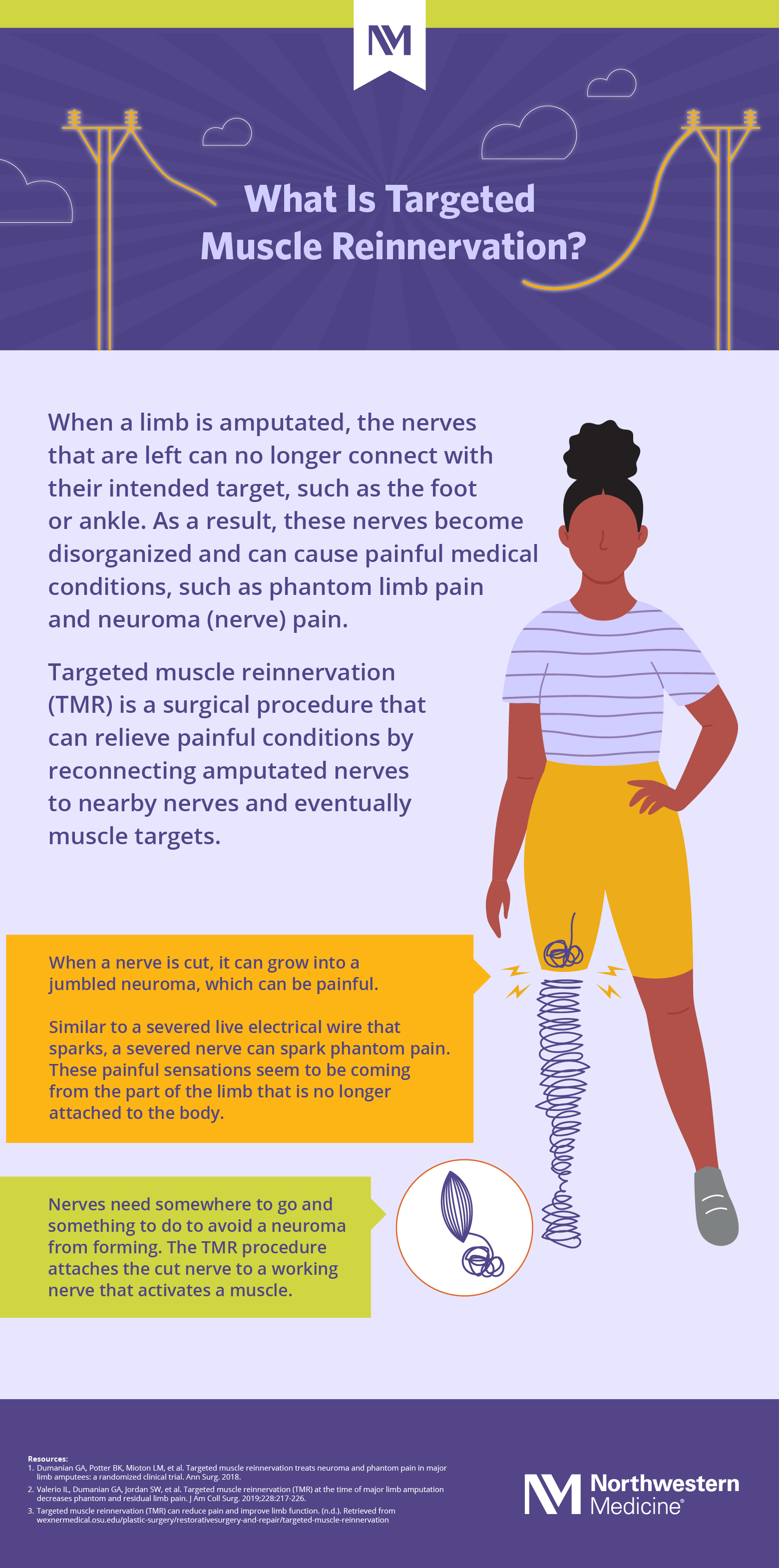 A drawing of a person with a below-the-knee amputation and a cut nerve forming a neuroma. Reconnection of cut nerve to a muscle also shown. Text on the infographic reads: When a limb is amputated, the nerves that are left can no longer connect with their intended target, such as the foot or ankle. As a result, these nerves become disorganized and can cause painful medical conditions, such as phantom limb pain and neuroma (nerve) pain.
Targeted muscle reinnervation (TMR) is a surgical procedure that can relieve painful conditions by reconnecting amputated nerves to nearby nerves and eventually muscle targets. When a nerve is cut, it can grow into a jumbled neuroma, which can be painful. Similar to a severed live electrical wire that sparks, a severed nerve can spark phantom pain. These painful sensations seem to be coming from the part of the limb that is no longer attached to the body. Nerves need somewhere to go and something to do to avoid a neuroma from forming. The TMR procedure attaches the cut nerve to a working nerve that activates a muscle.