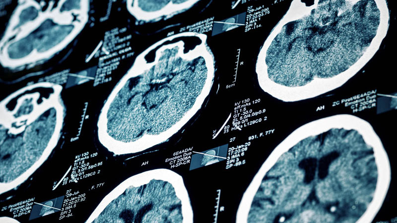 nm-a-new-technology-to-identify-stroke-risk-preview