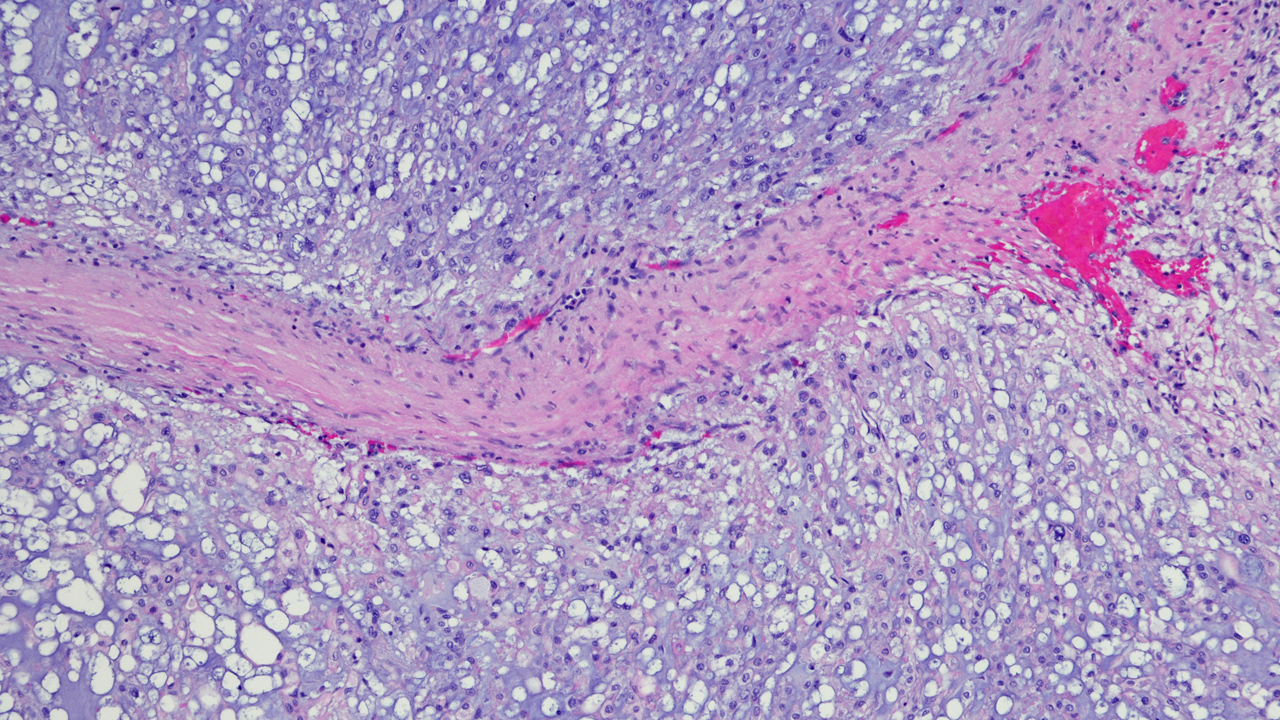 nm-chordoma-one-in-a-million_feature